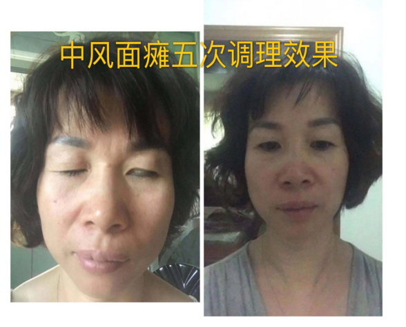 中风后遗症1