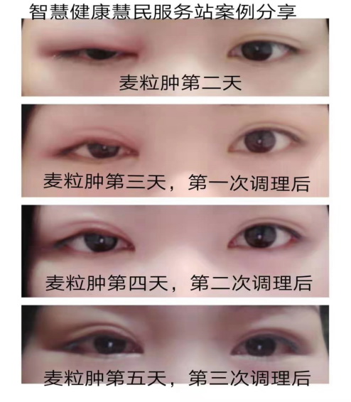 麦粒肿