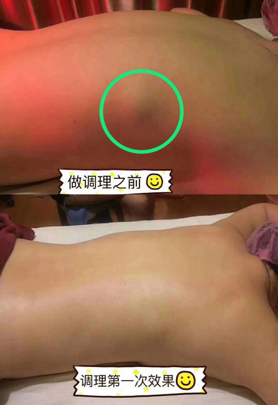脂肪瘤
